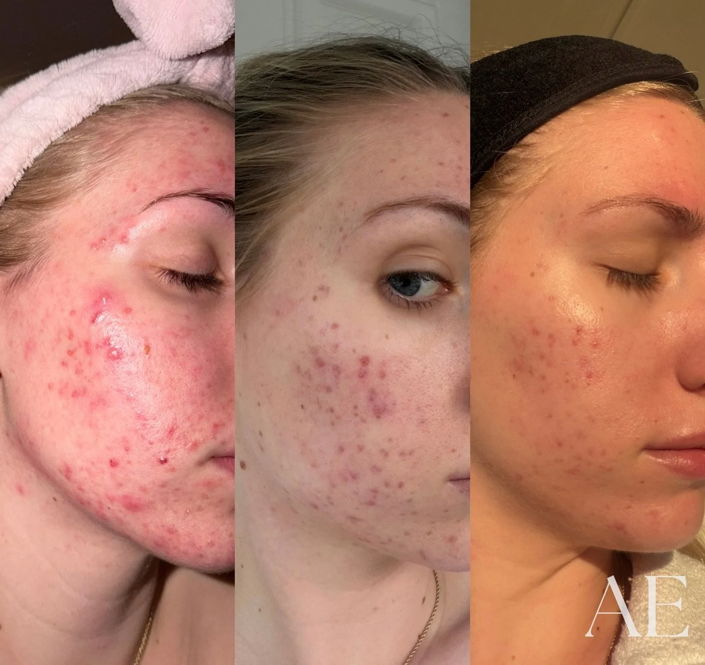 6 months of constant communication, dedication, trust and a positive mindset👏🏼🩵 

we also only did 2 treatments in between these photos because she lives a bit farther from me!

focusing on barrier support, hydration and calming her inflammation w