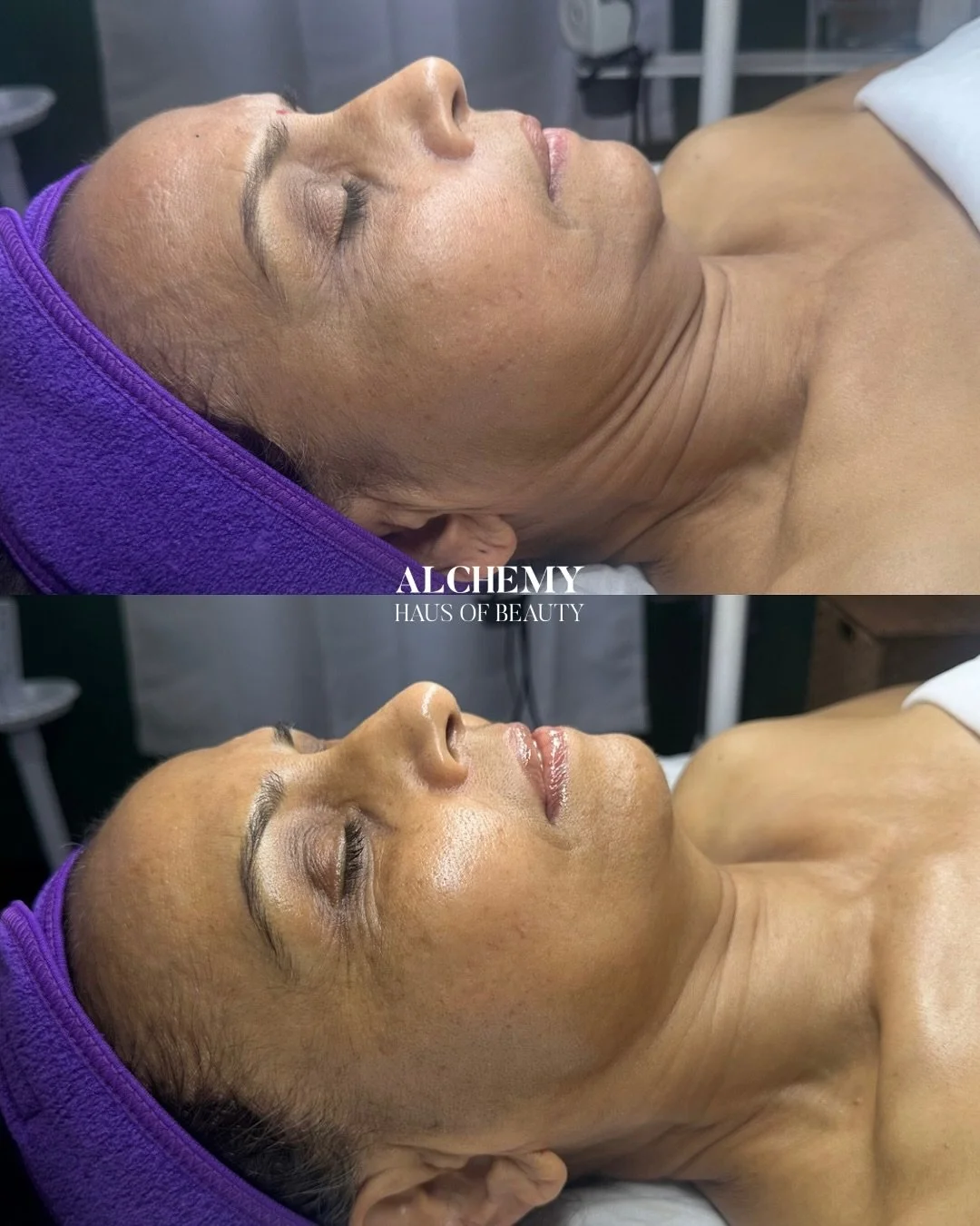 Oh yesss honey 😍 no Botox, no filler, just our signature Alchemy Haus touch 🔮✨ 
1 hour and 45 minutes of customized healing. This is QUICKLY becoming one of our favorite treatments.
During this treatment, we invoked the magic of @circadia Firming