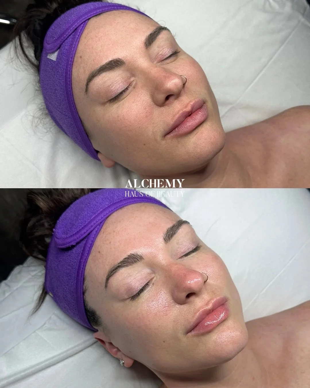Korean Glass Skin Facial Level 3: The Ultimate Transformation🪞✨
This treatment never disappoints. These pictures were after two sessions of our Korean Glass Skin Facial Level 3. 90 minutes of K-Beauty bliss. 
Every month we customize my beautiful