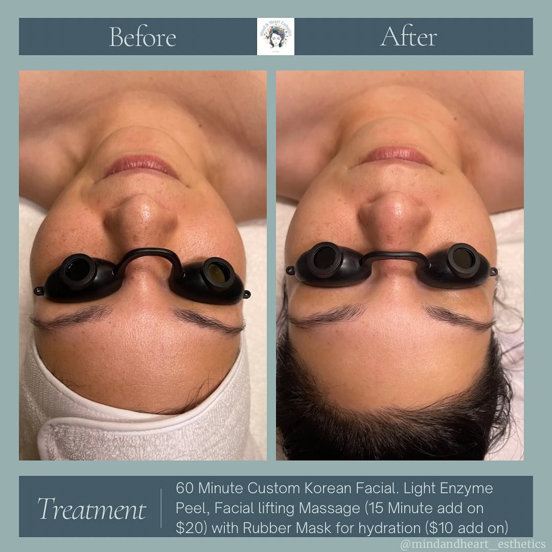 ✨Client Spotlight✨

This lovely client came in with concerns about dry, dehydrated skin, so we focused on replenishing her skin with deep hydration and essential nutrients. 🧖&zwj;♀️

We started with a custom 60-minute Korean facial, designed to infu