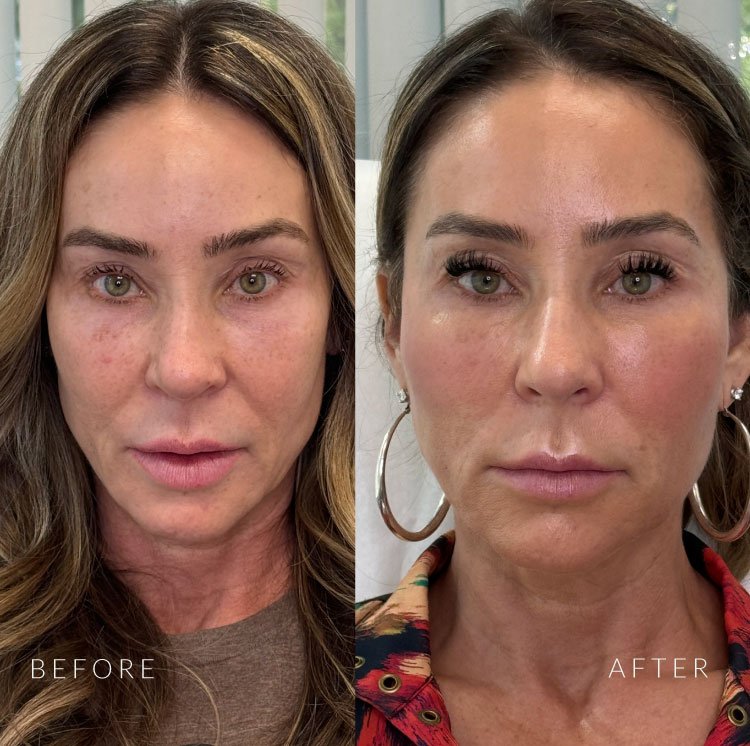 Before and After