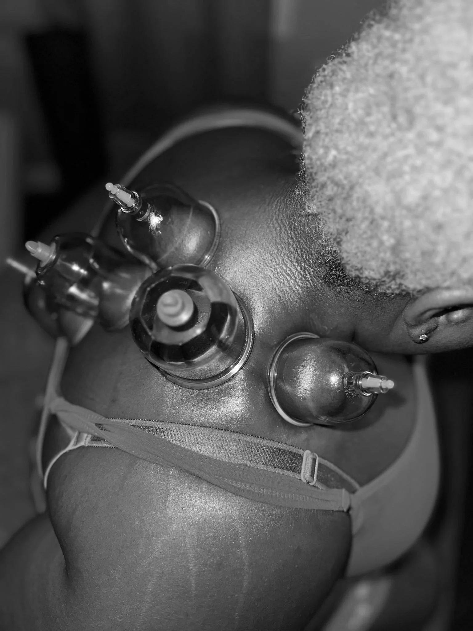 Cupping Therapy at Ultimate Touch Therapeutic in Cary North Carolina