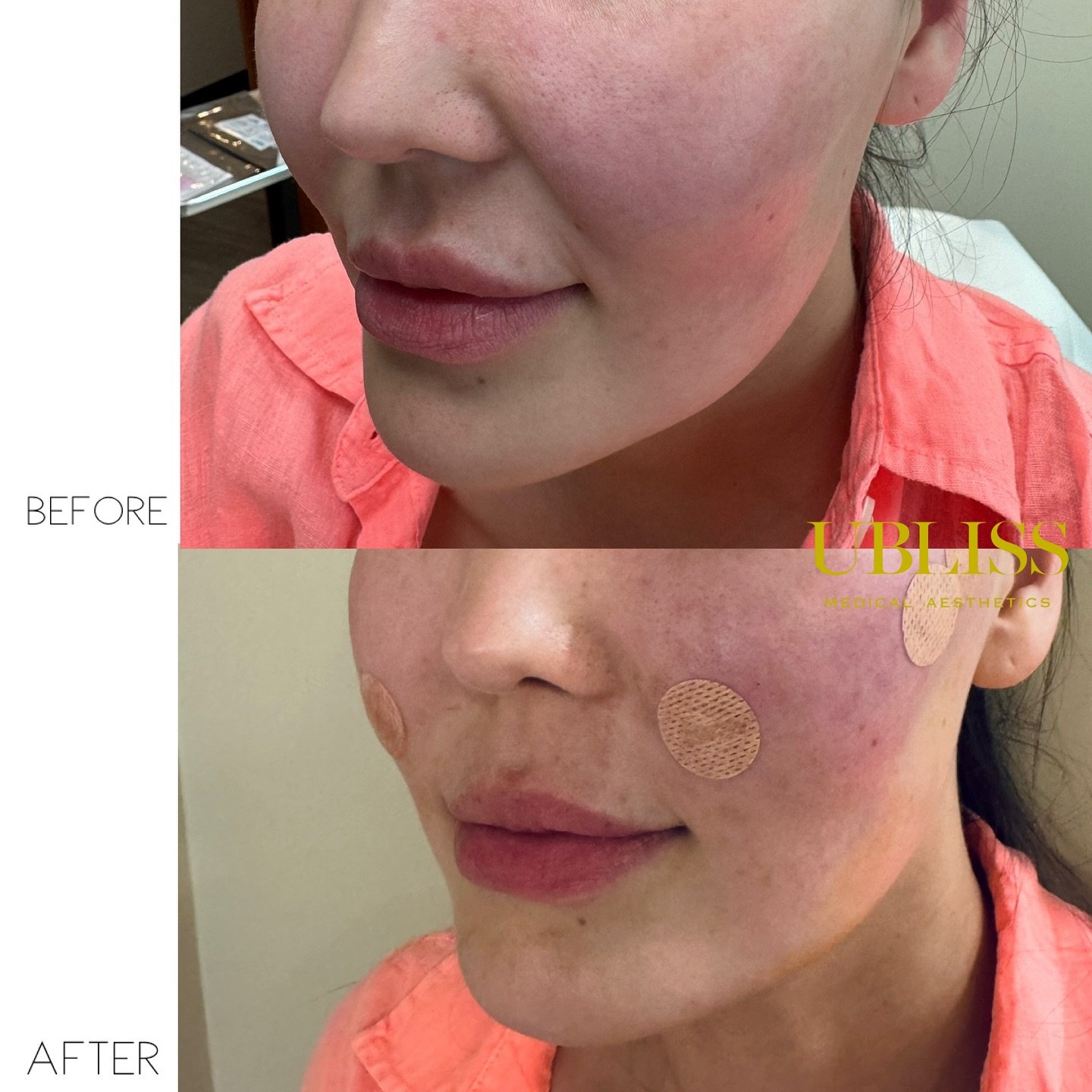 ✨ Smile Line Smoothed. Jawline Snatched.✨
Check out this beautiful transformation with Thread Lifting @mintpdo 🙌
In just one session, we softened deep nasolabial folds (smile lines) and lifted the midface for that naturally snatched, contoured look?