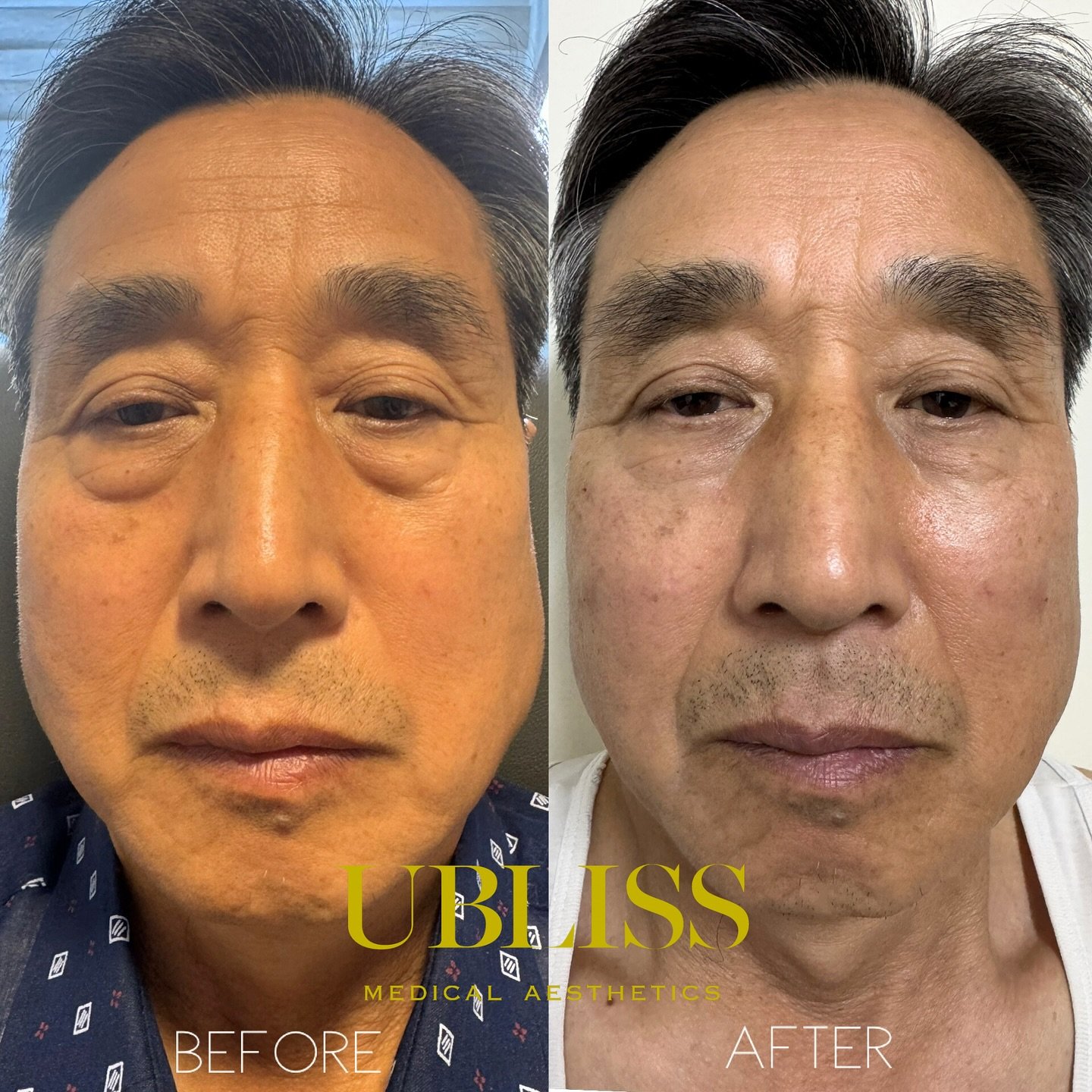✨ Real Results. No Surgery. ✨
Say hello to a brighter, lifted under-eye &mdash; with the Crepe Cake Filler Technique using filler from @teoxanerhacollection_usa @revanceaesthetics and cannula from @facemedstore, exclusively trained by Dr. Woonjin Koh
