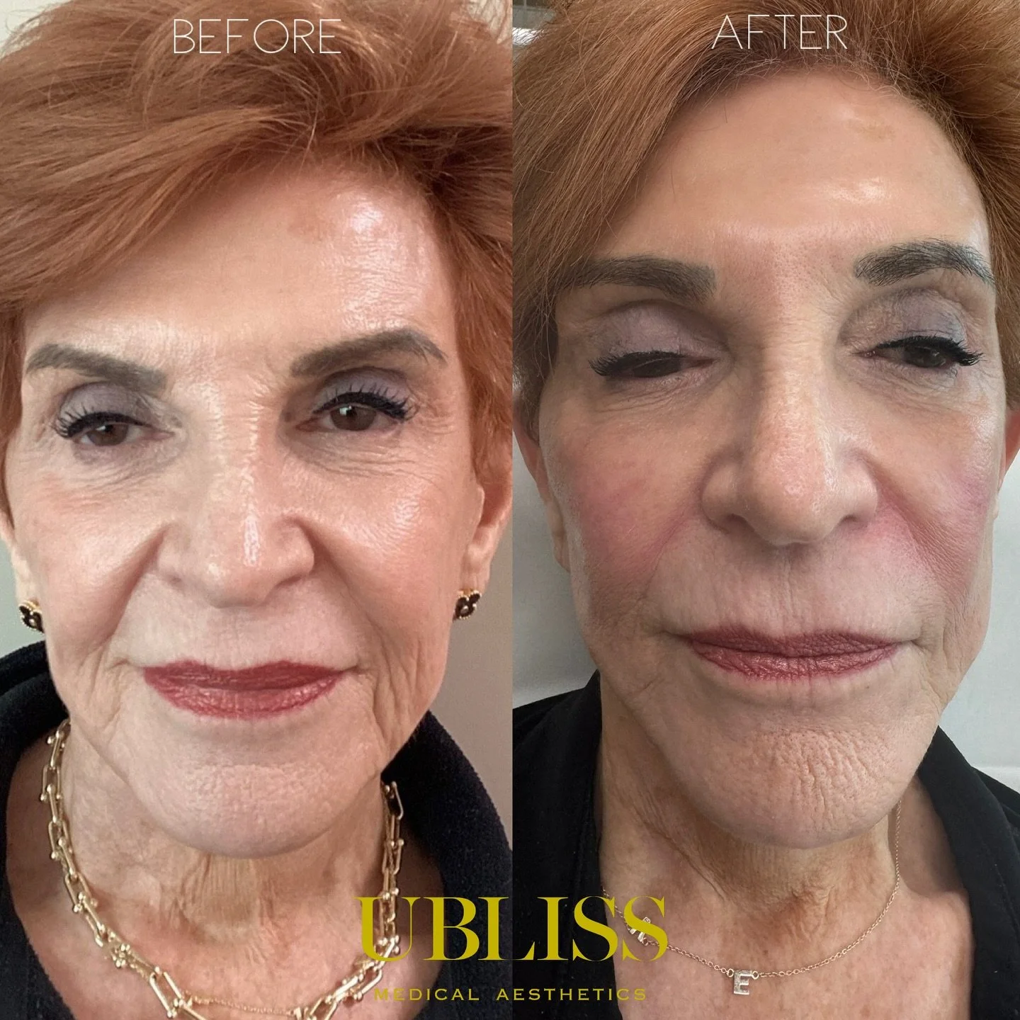 ✨Tighter Skin, Softer Lines, Youthful Contour
After just 2 sessions of Sylfirm X @sylfirmx.usa @benevskinscience , skin texture is noticeably smoother and tighter&mdash;especially in the lower face and jawline 💆&zwj;♀️✨
Used @rejuran_usa_sale skin b
