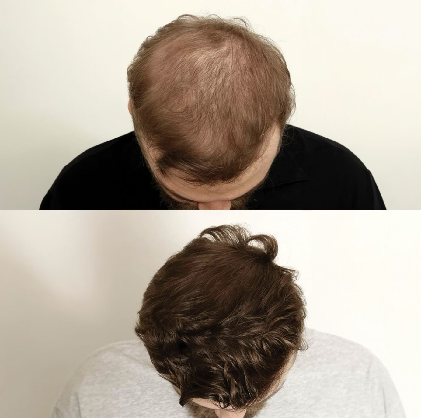 Comparison of a man's head before and after hair treatment, showing increased hair volume and style.
