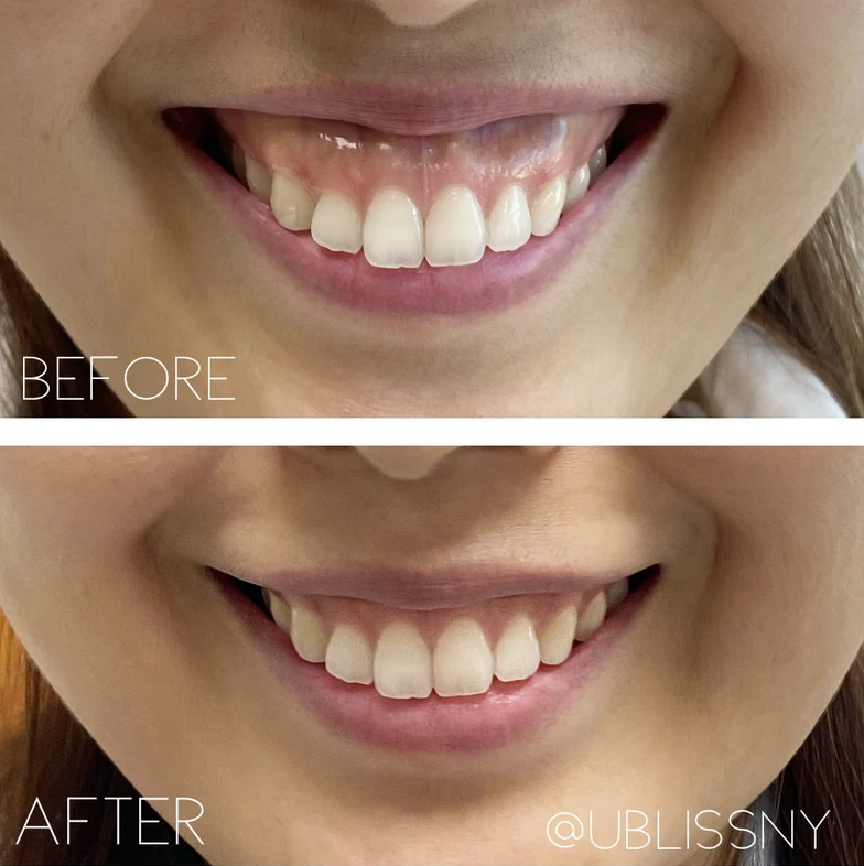 Gummy Smile.png