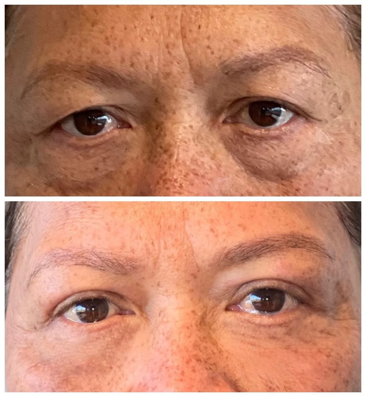 Eyelid Surgery Recovery: What to Expect and How to Heal Beautifully