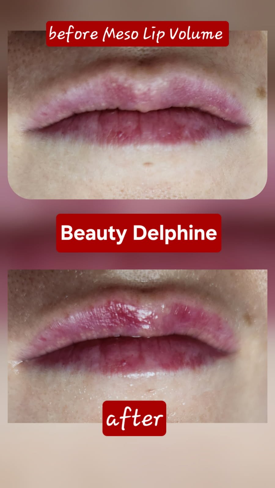 Comparison of lips before and after Meso Lip Volume treatment, showing improved volume and moisture for Beauty Delphine.