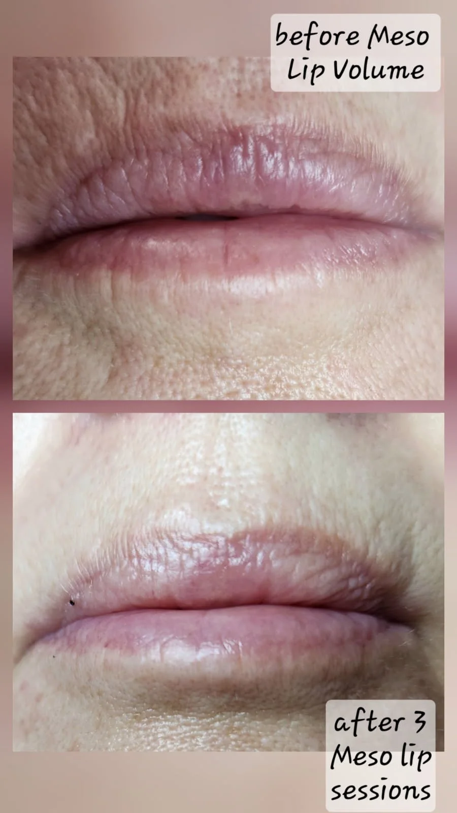Close-up of lips showing before and after three Meso Lip sessions, with the top image labeled 'before Meso Lip Volume' and the bottom labeled 'after 3 Meso Lip sessions'.