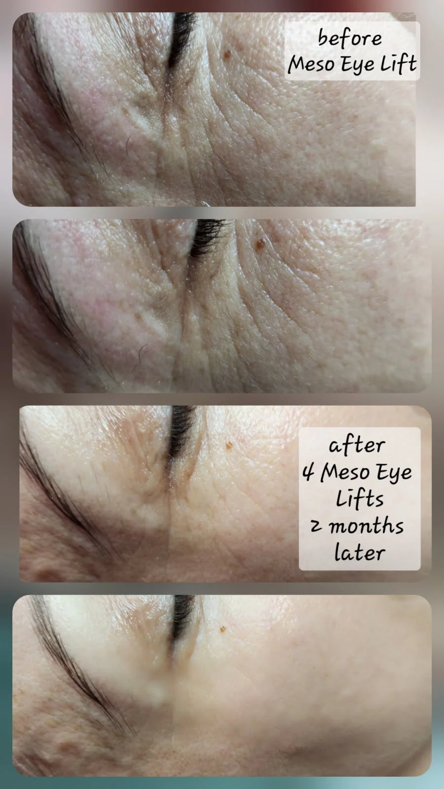 Progress photos of a person's eye area before and after four meso eye lift treatments, showing reduced wrinkles over two months.
