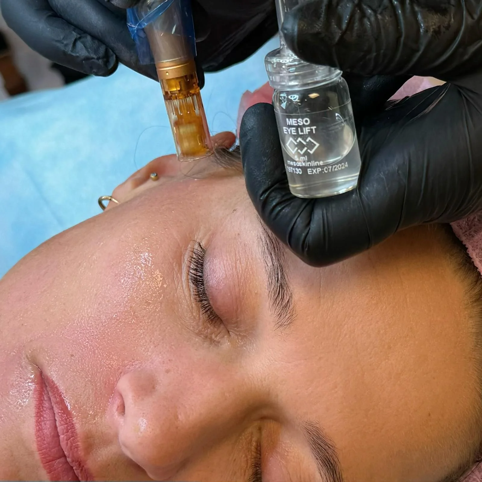 A person receiving a cosmetic procedure on their face, with a close-up view of their forehead and closed eyes. A medical professional wearing black gloves is holding a small glass container labeled 'MESO EYE LIFT' containing a clear solution. The professional is using a device connected to this solution, possibly for a skin treatment or injection.