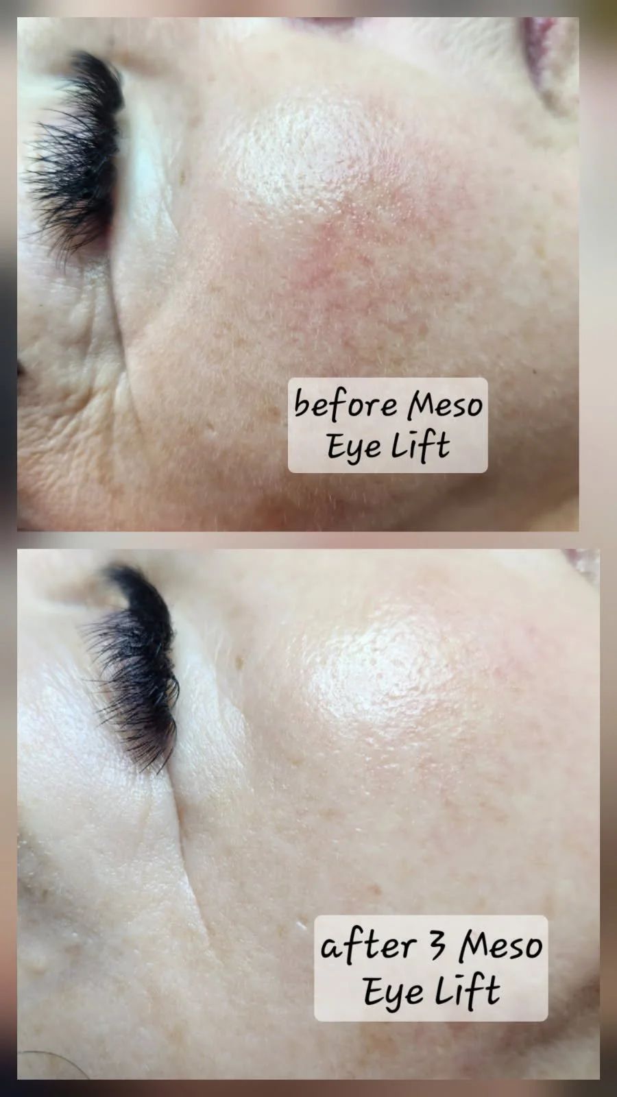 Close-up images showing skin around an eye before and after a three-session Meso Eye Lift, with smoother skin visible after the treatments.