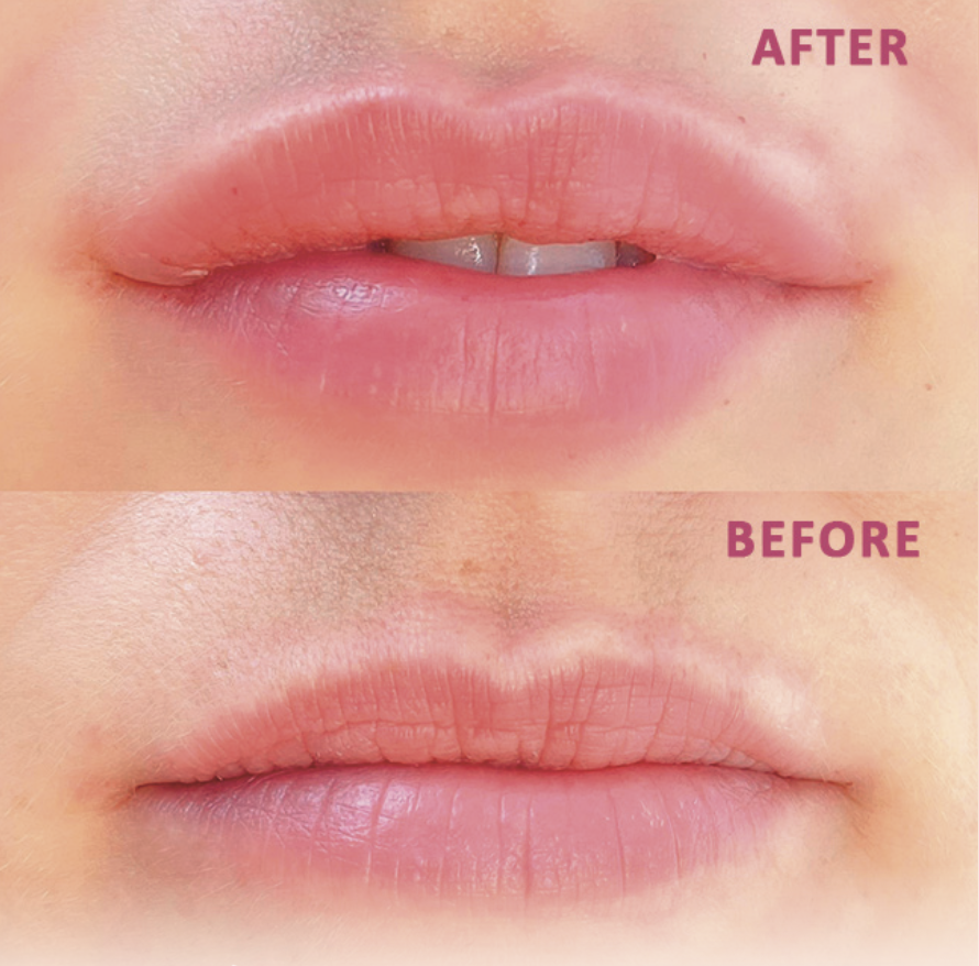 Close-up of lips showing before and after cosmetic lip treatment. The 'before' lip shows dry, chapped lips, while the 'after' lip appears smoother and more hydrated.