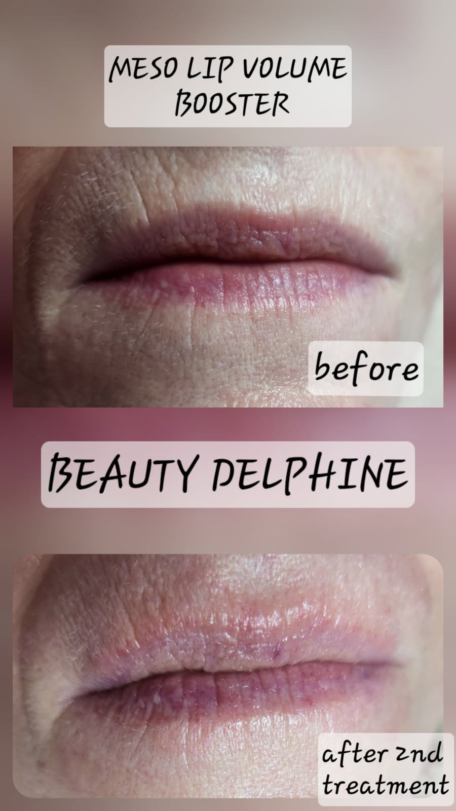 Close-up of lips before and after second treatment with MESO Lip Volume Booster by Beauty Delphine, showing improved lip volume and texture.