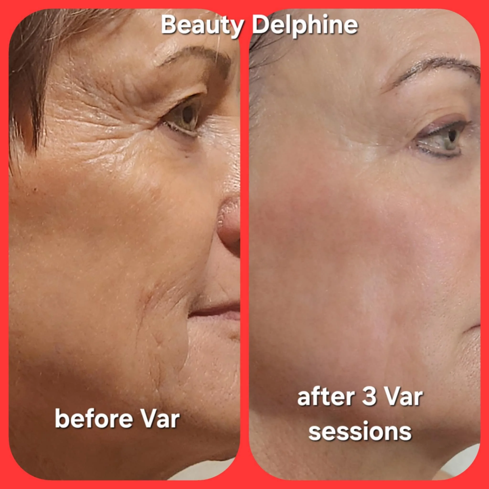 Side-by-side comparison photo showing the face of a woman before and after three sessions of cosmetic treatment. The left image shows the woman with wrinkles around her eye and forehead, while the right image shows smoother skin with fewer wrinkles.
