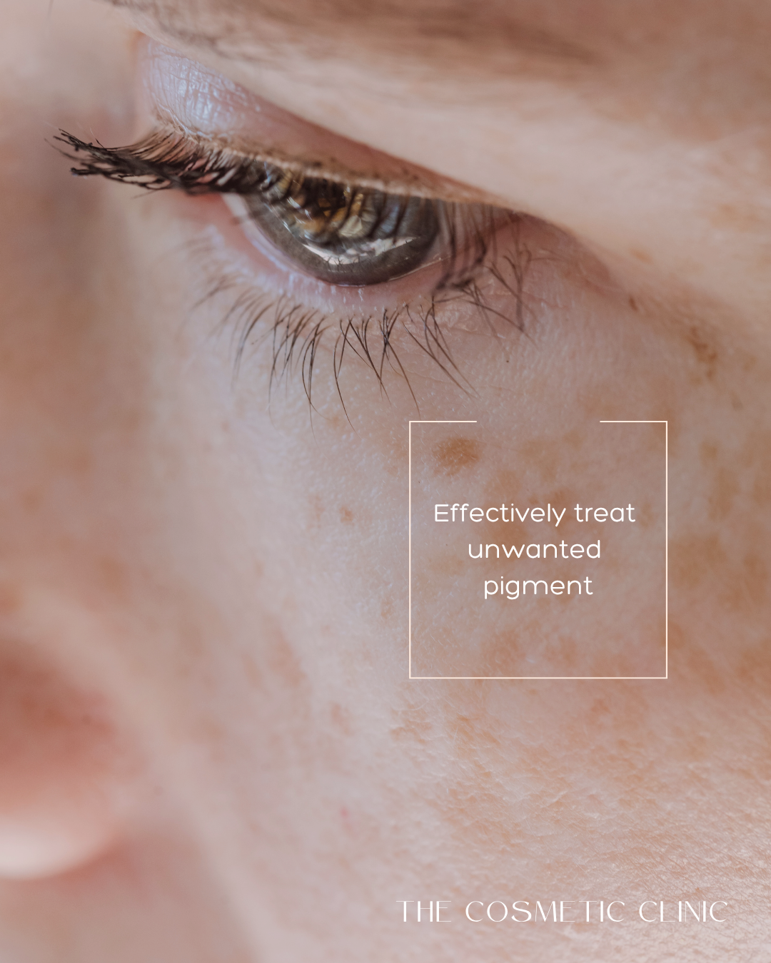 The Right Way to Treat Melasma and Sun Damage