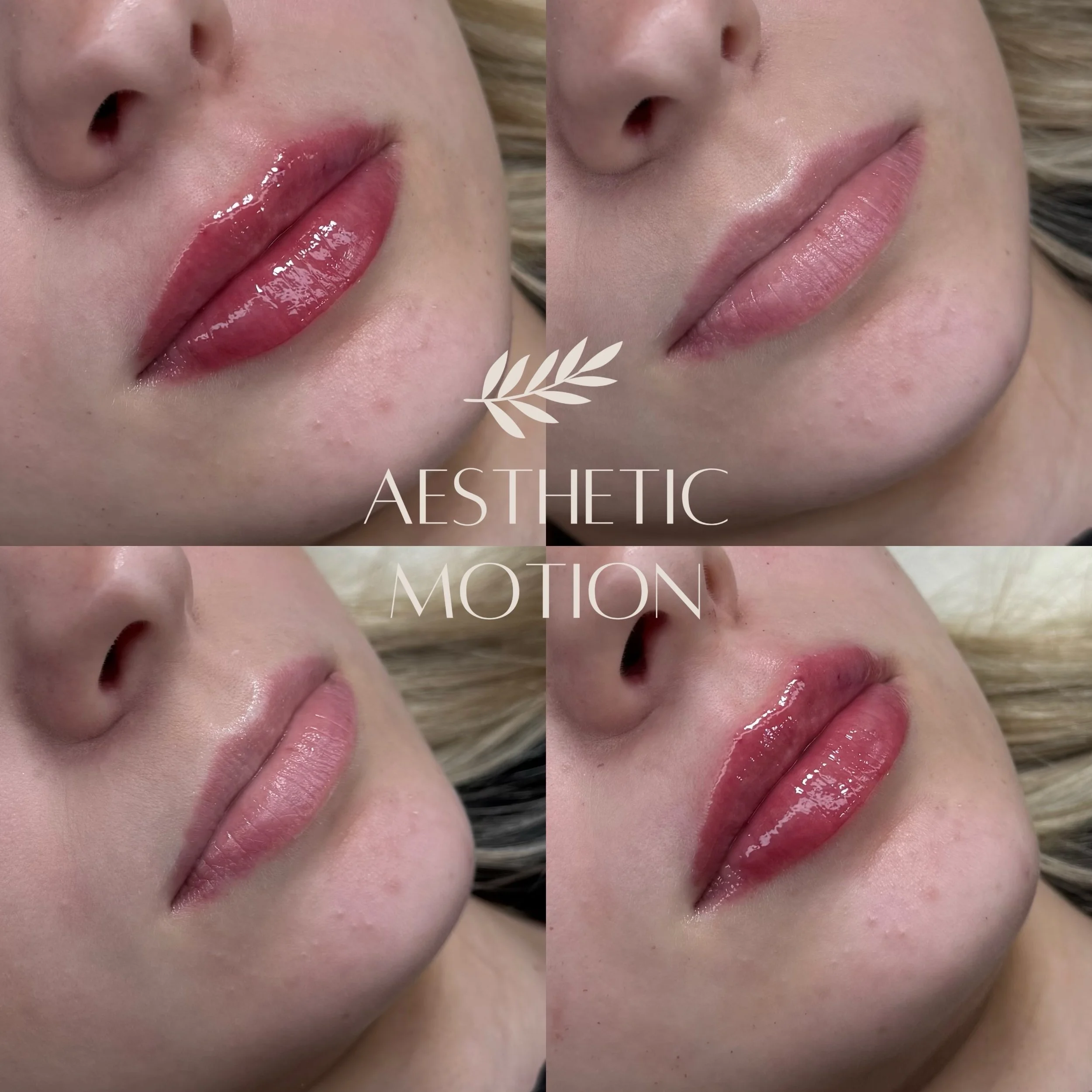 Luonnollinen lopputulos edell&auml;💋 Juvederm ultra smile 0,55ml💉

#huultent&auml;ytt&ouml;lahti#huultenmuotoilu#t&auml;yteainehoidot#huuletlahti#t&auml;yteainehoidotlahti