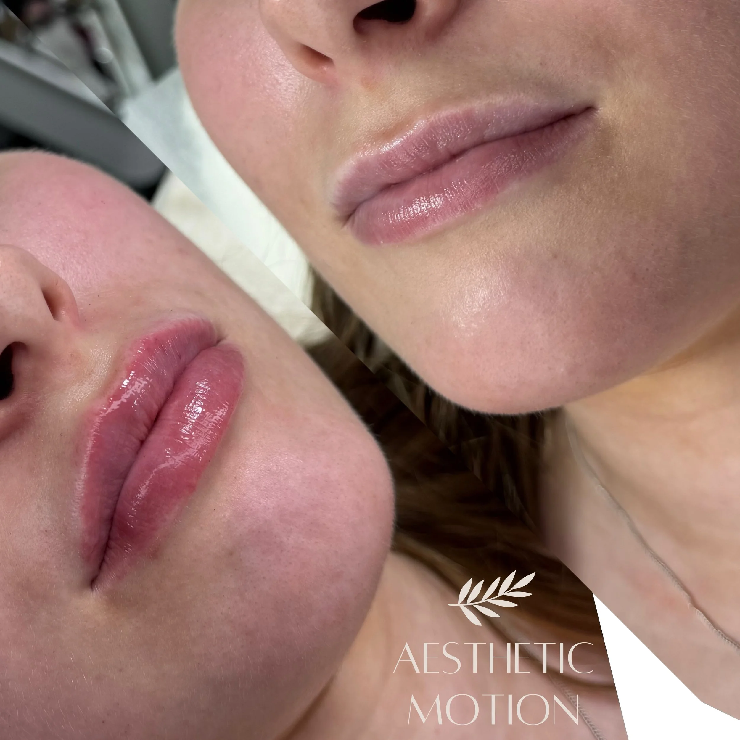 💋 Huuliin luonnollista raikkautta t&auml;yteainehoidolla💉

#huultent&auml;ytt&ouml;lahti#huultenmuotoilu#t&auml;yteainehoidotlahti#huuletlahti#t&auml;yteainehoidot
