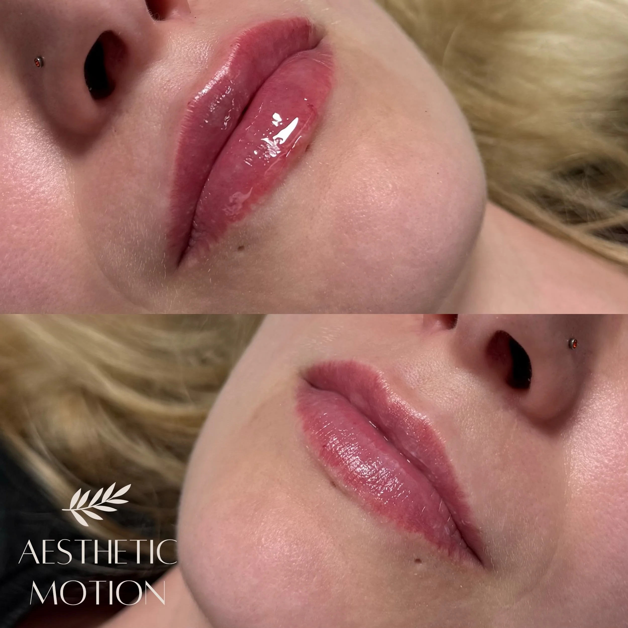 💋 Huulten yll&auml;pitohoito 💉

Edellinen huulten t&auml;yteainehoito oli tehty noin vuosi sitten, ja aiempaa t&auml;yteainetta oli edelleen mukavasti j&auml;ljell&auml;. ✨

Yll&auml;pitohoidossa raikastimme huulten muotoa ja lis&auml;simme kevyest