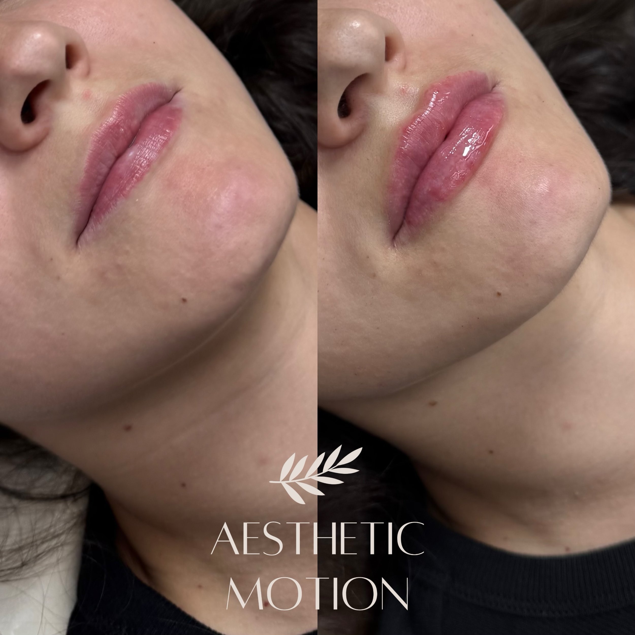 💋 Huulten t&auml;yteainehoito Stylage Special Lips -t&auml;yteaineella 💉

Asiakkaan toiveena oli n&auml;kyv&auml;mpi volyymin lis&auml;ys s&auml;ilytt&auml;en huulten luonnollinen tuntuma.

#huultent&auml;ytt&ouml;lahti#huultenmuotoilu#t&auml;yteai