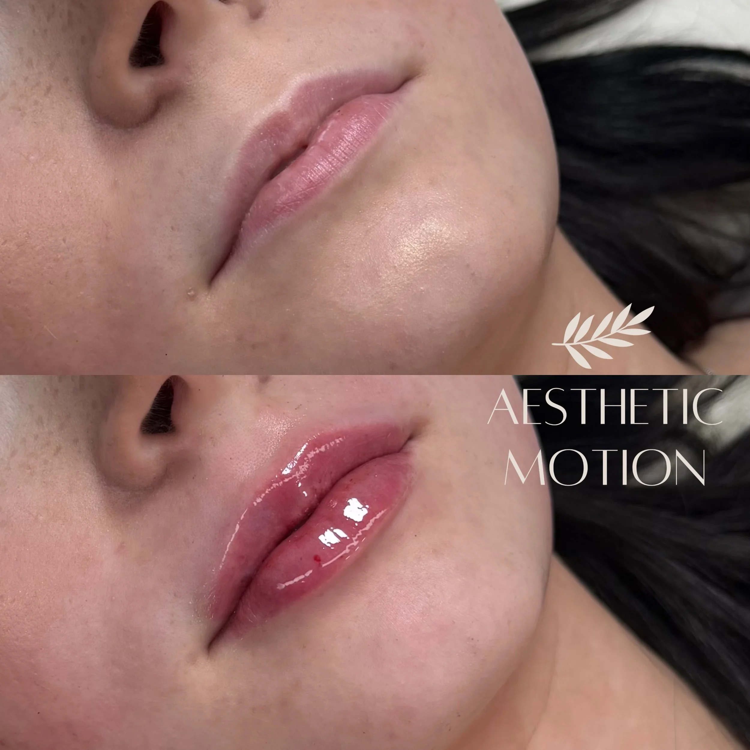 Pehme&auml; ja luonnollinen lopputulos💋 Stylage special lips💉

#huultent&auml;ytt&ouml;lahti#huultenmuotoilu#t&auml;yteainehoidot#t&auml;yteainehoidotlahti#huuletlahti