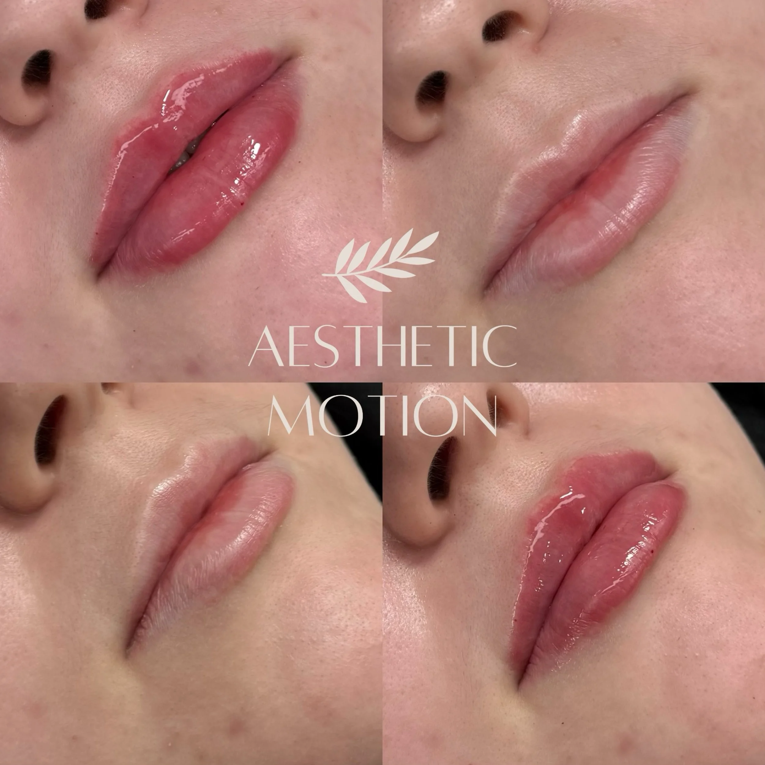 Symmetriaa ja tasapainoa huulille t&auml;yteainehoidolla 💉💋
Kauniisti muotoillut ja luonnollisen n&auml;k&ouml;iset huulet, joissa mittasuhteet ovat harmoniassa. ✨

#huultent&auml;ytt&ouml;lahti#huultent&auml;yteainehoito#t&auml;yteainehoidotlahti#