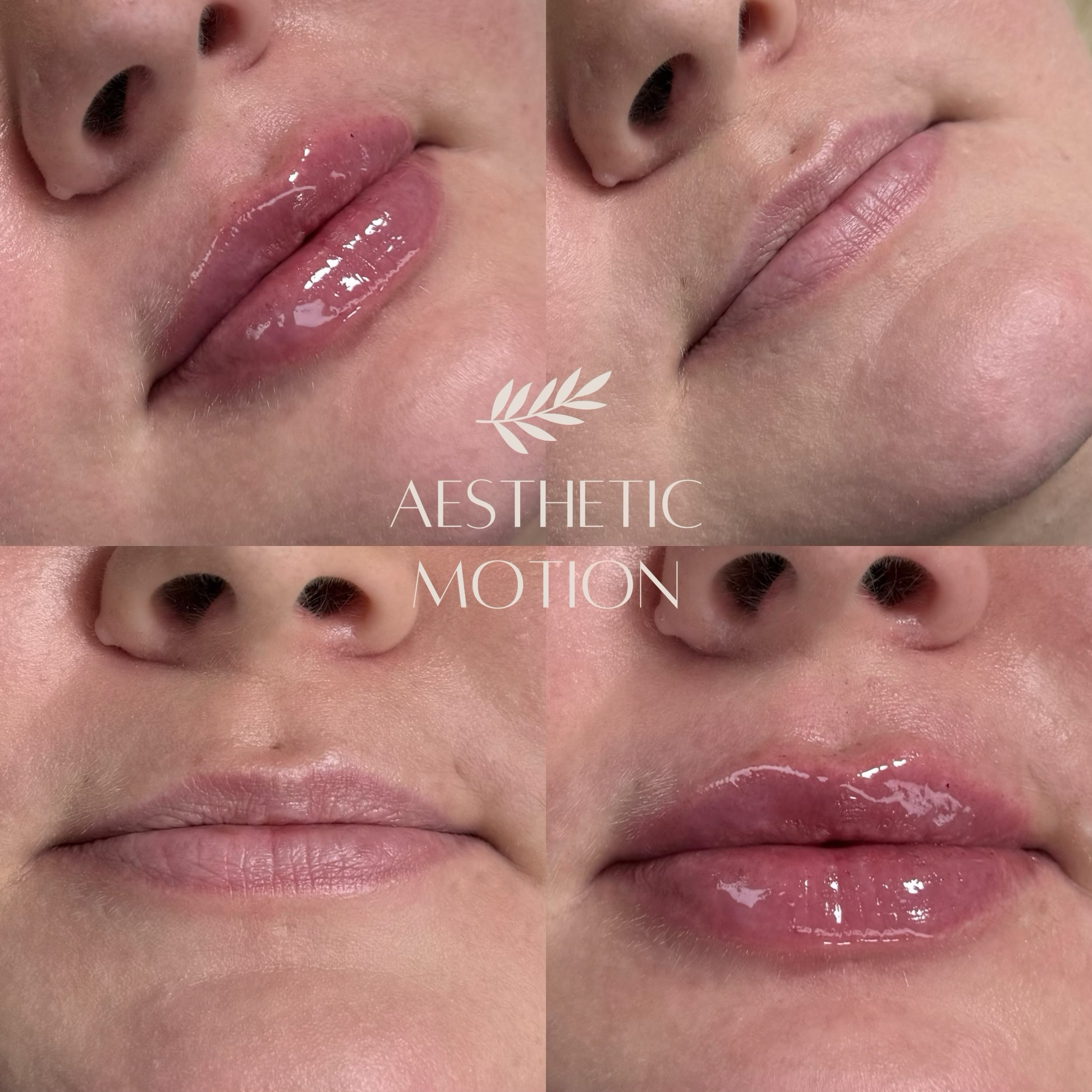 N&auml;ytt&auml;v&auml; ja pitk&auml;kestoinen lopputulos huulten t&auml;yteainehoidolla💋Stylage Lips Plus 💉

T&auml;ytel&auml;isyytt&auml;, kaunista muotoa ja n&auml;ytt&auml;v&auml;&auml; volyymia huulille asiakkaan toiveiden mukaan🤍

#huultenmu