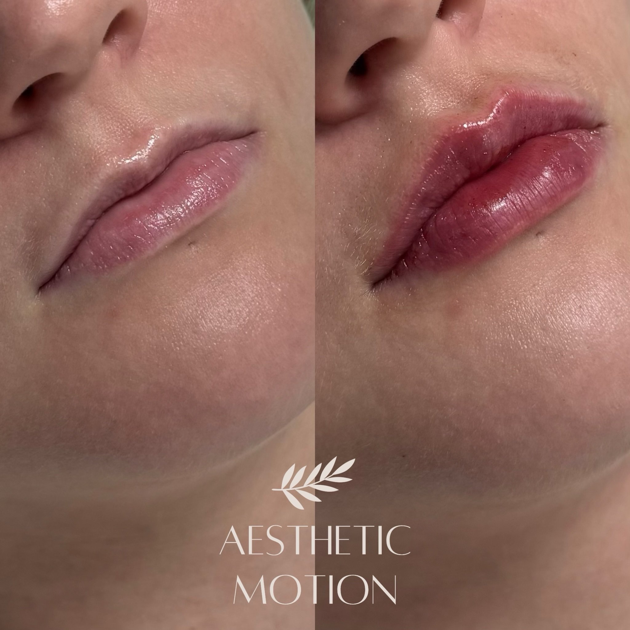 M-muotoisten huulten muotoilu Teosyal RHA KISS t&auml;yteaineella💉

Kauniisti korostunut huulten muoto ja luonnollinen t&auml;ytel&auml;isyys, pehmeys ja luonnollinen liikkuvuus s&auml;ilyttaen💋

#huultent&auml;ytt&ouml;lahti#t&auml;yteainehoidot#h
