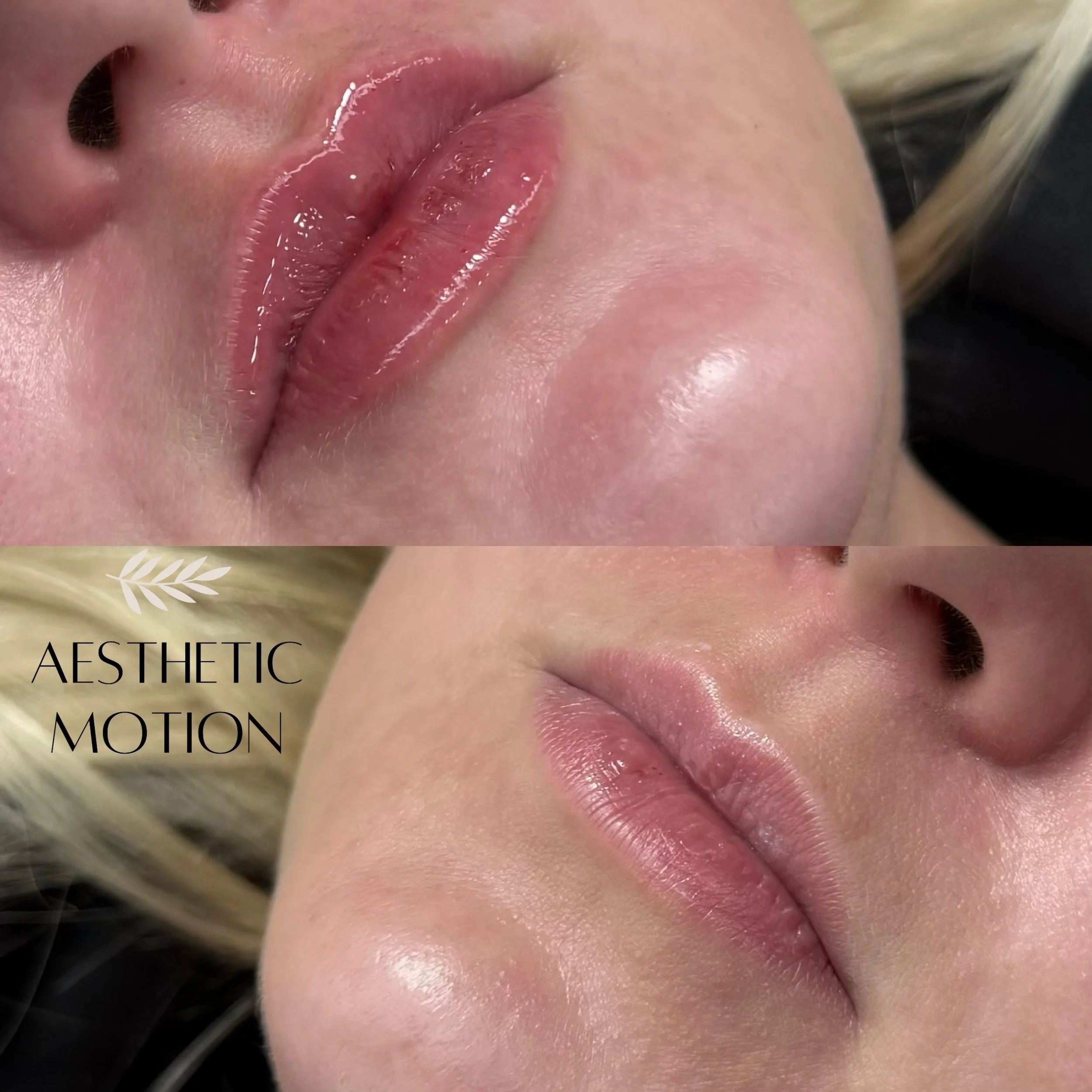 Kauniiden huulten korostus Juvederm Ultra Smile -t&auml;yteaineella 💉💋

#huultent&auml;ytt&ouml;lahti#huultent&auml;ytt&ouml;#t&auml;yteainehoidot#t&auml;yteainehoidotlahtihuuletlahti