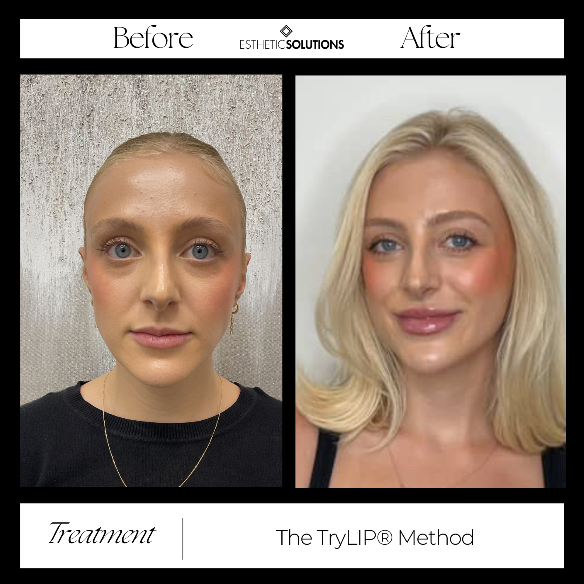 The TryLIP® Method: A Smarter Approach to Lip Enhancement at Every Age