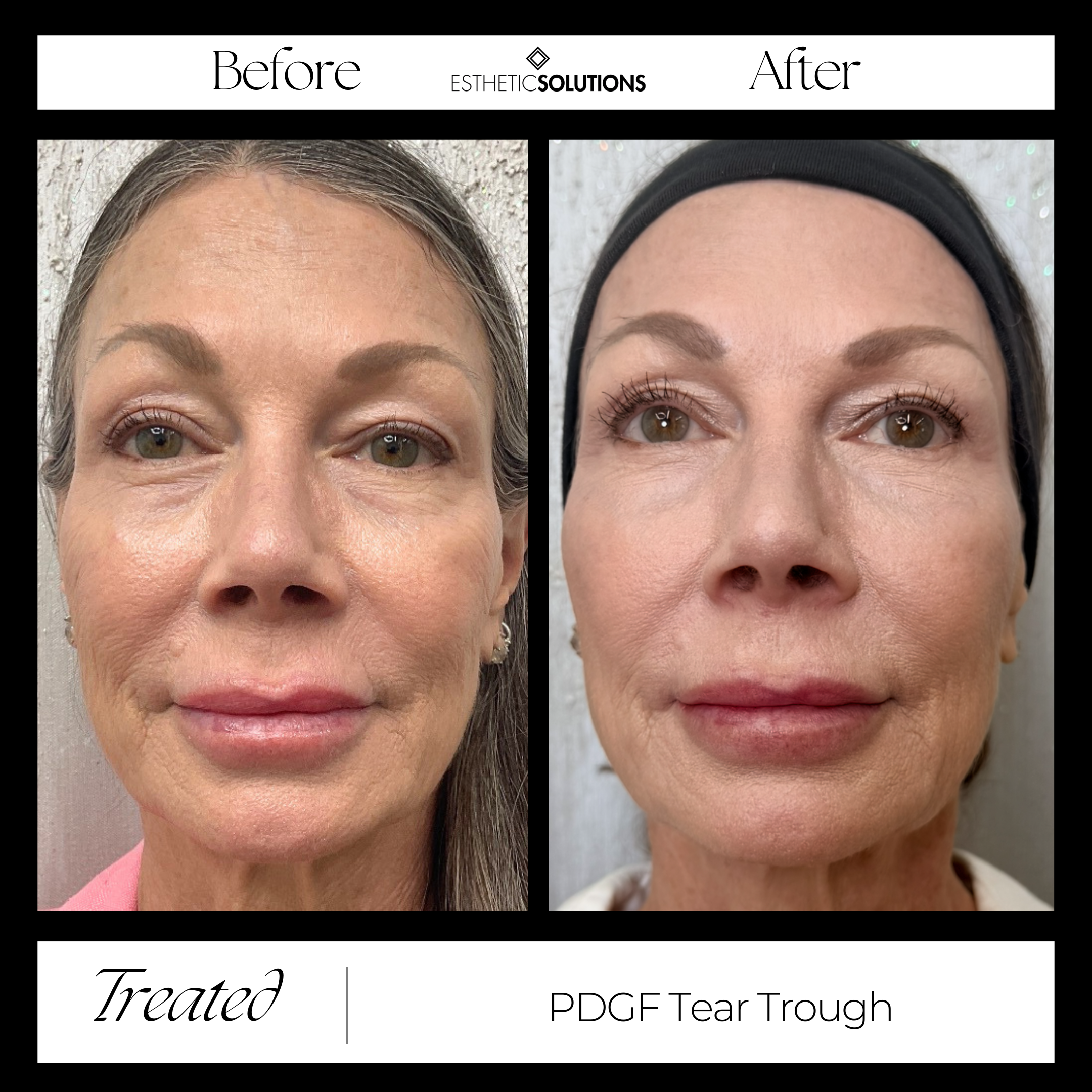 PDGF Tear Trough Treatment in Scottsdale &amp; Peoria, Arizona