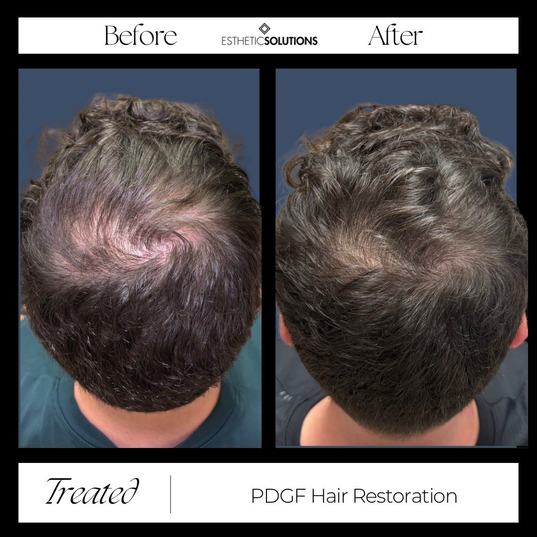 PDGF Hair Restoration in Scottsdale &amp; Peoria, Arizona