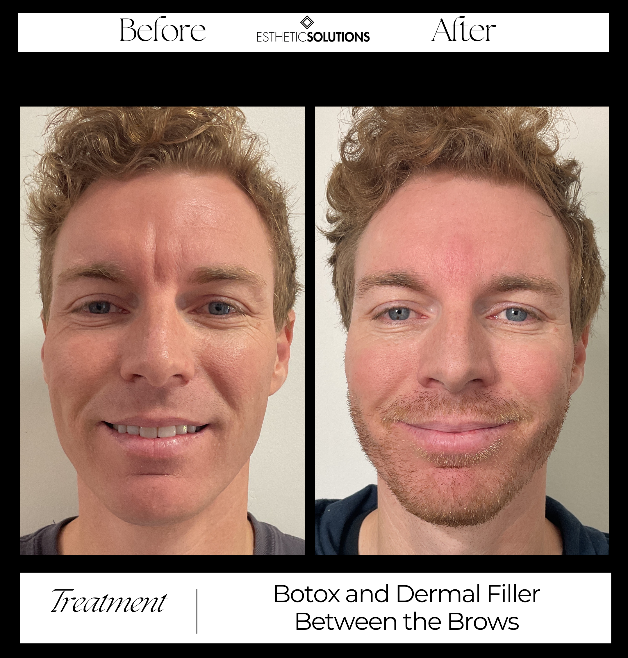 Male Client Before and After Image Botox and Filler Treatment