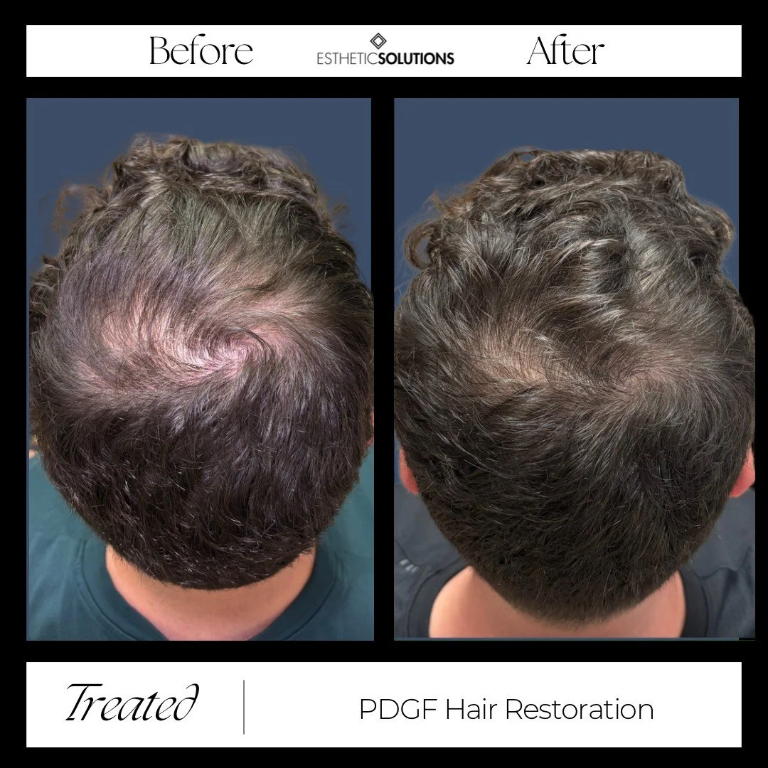 PDGF Hair Restoration Before and After Image