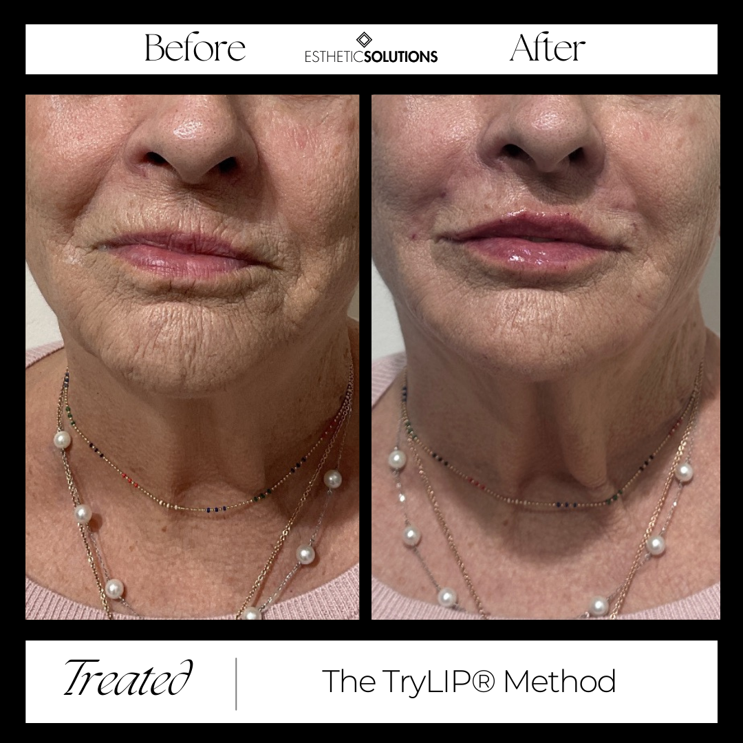Image of 50+ Clients Before and After TryLIP Method