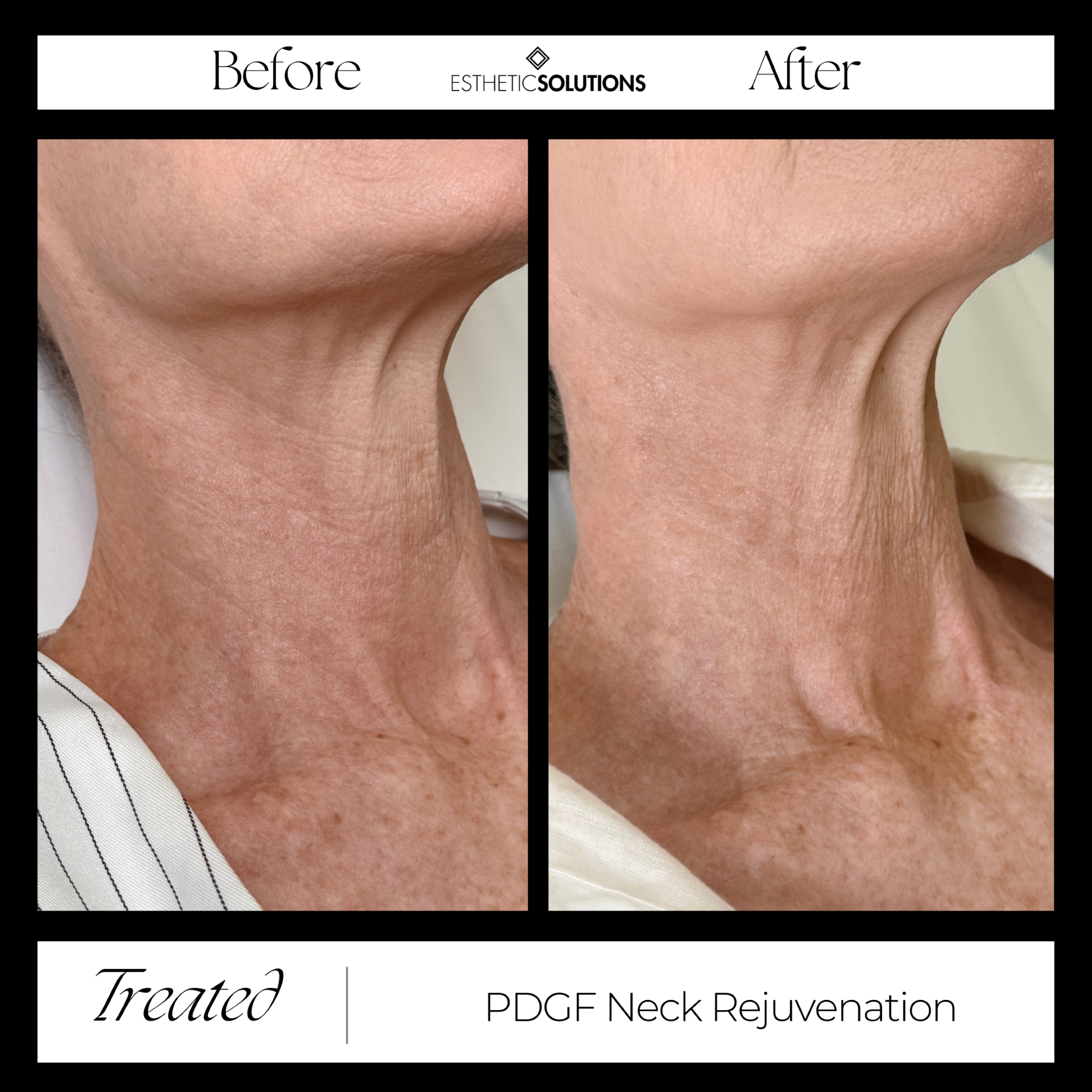 PDGF Neck Rejuvenation Before & After Image of Client