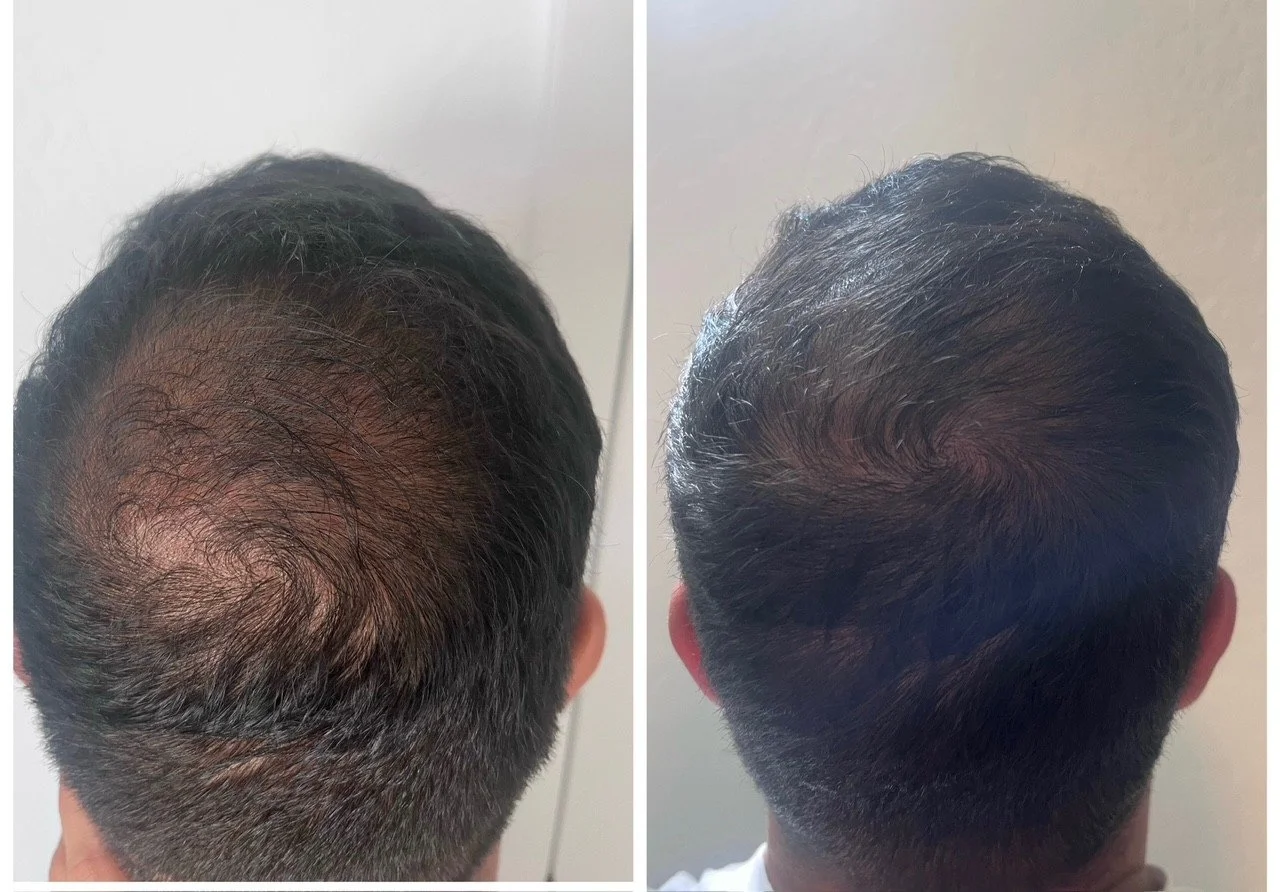 PDGF Hair Restoration Patient Before & After Image