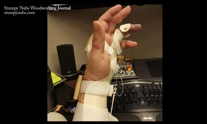 a contraption around a hand that's desiged to help strengthen an injured finger