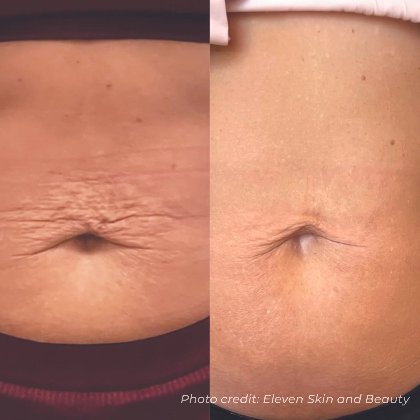 BA15_ELEVENSKIN&BEAUTY_DMF_ABDOMENSTRETCHMARKS_X1.jpg