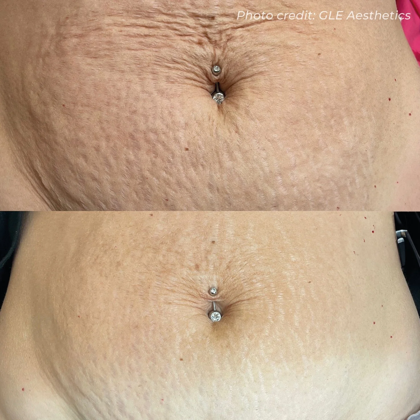 BA97_GLEAESTHETICS_DMF_ABDOMEN_X1_B&A.jpg
