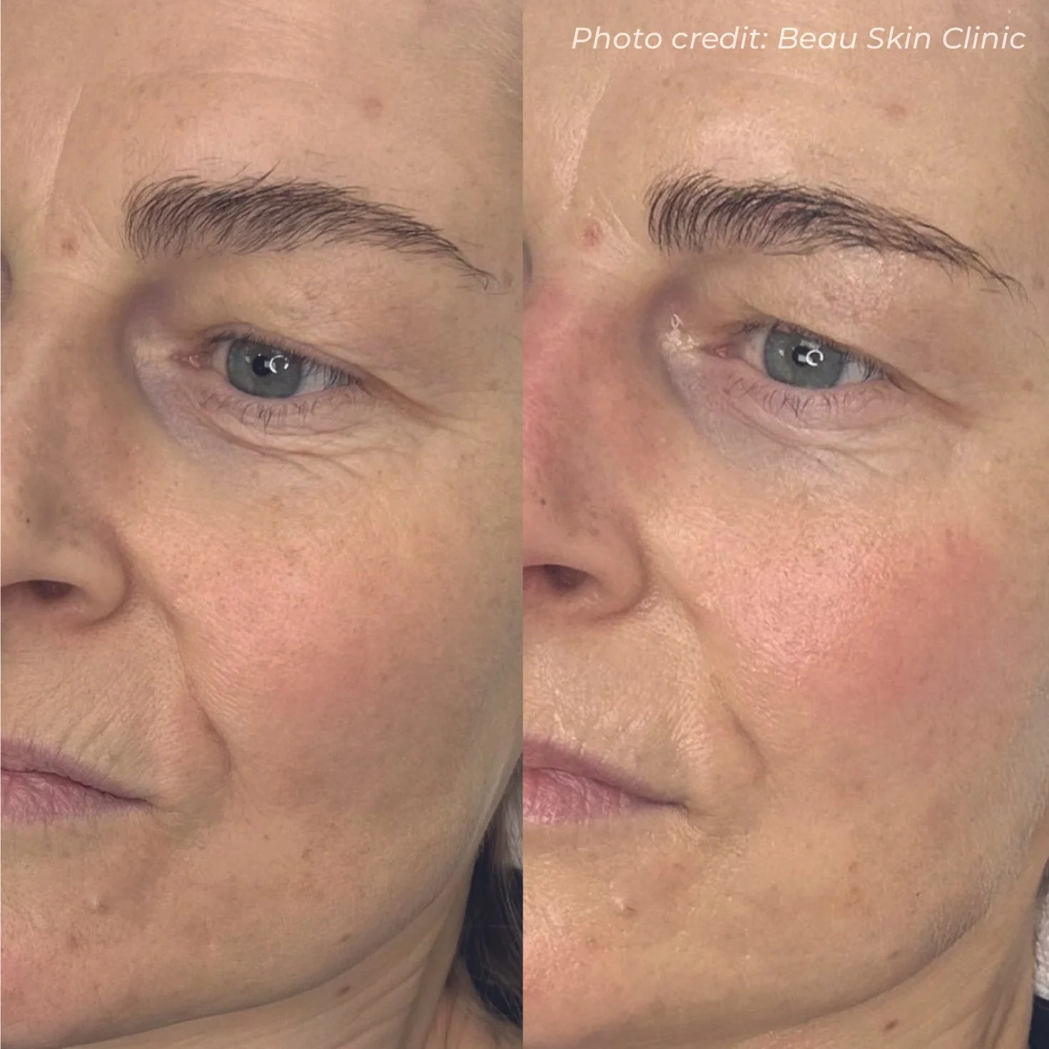 BA5_Beau Skin Clinic_HO2_1 session.jpg