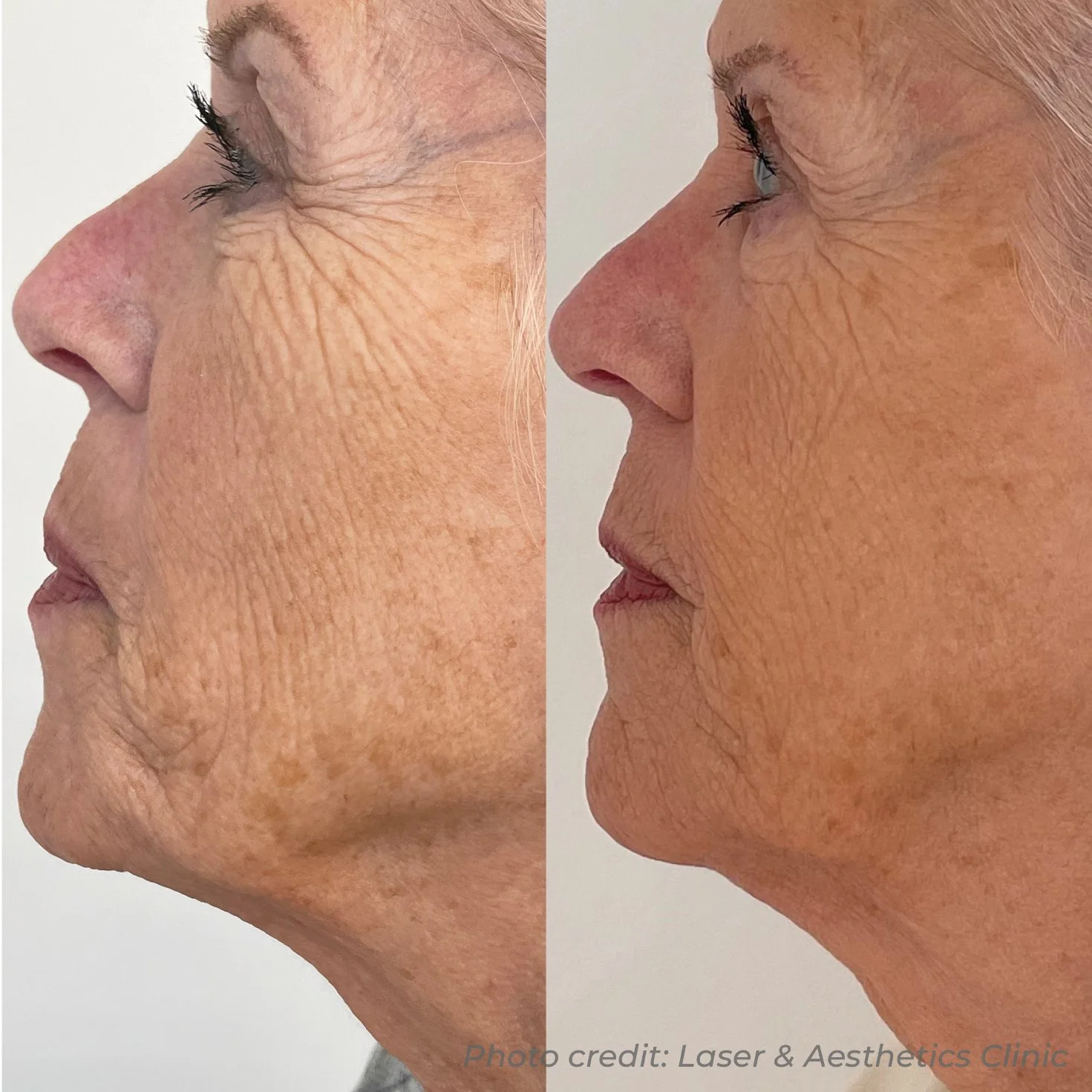 BA103_LASER&AESTHETICSCLINIC_DMF_FACE_X3_B&A.jpg