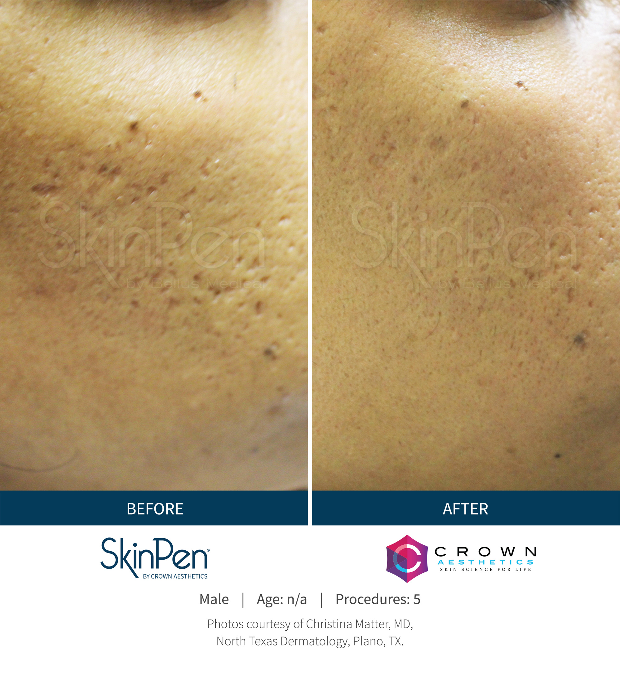 Scar Treatment Gallery: Microneedling — Aesthetic Medicine MD