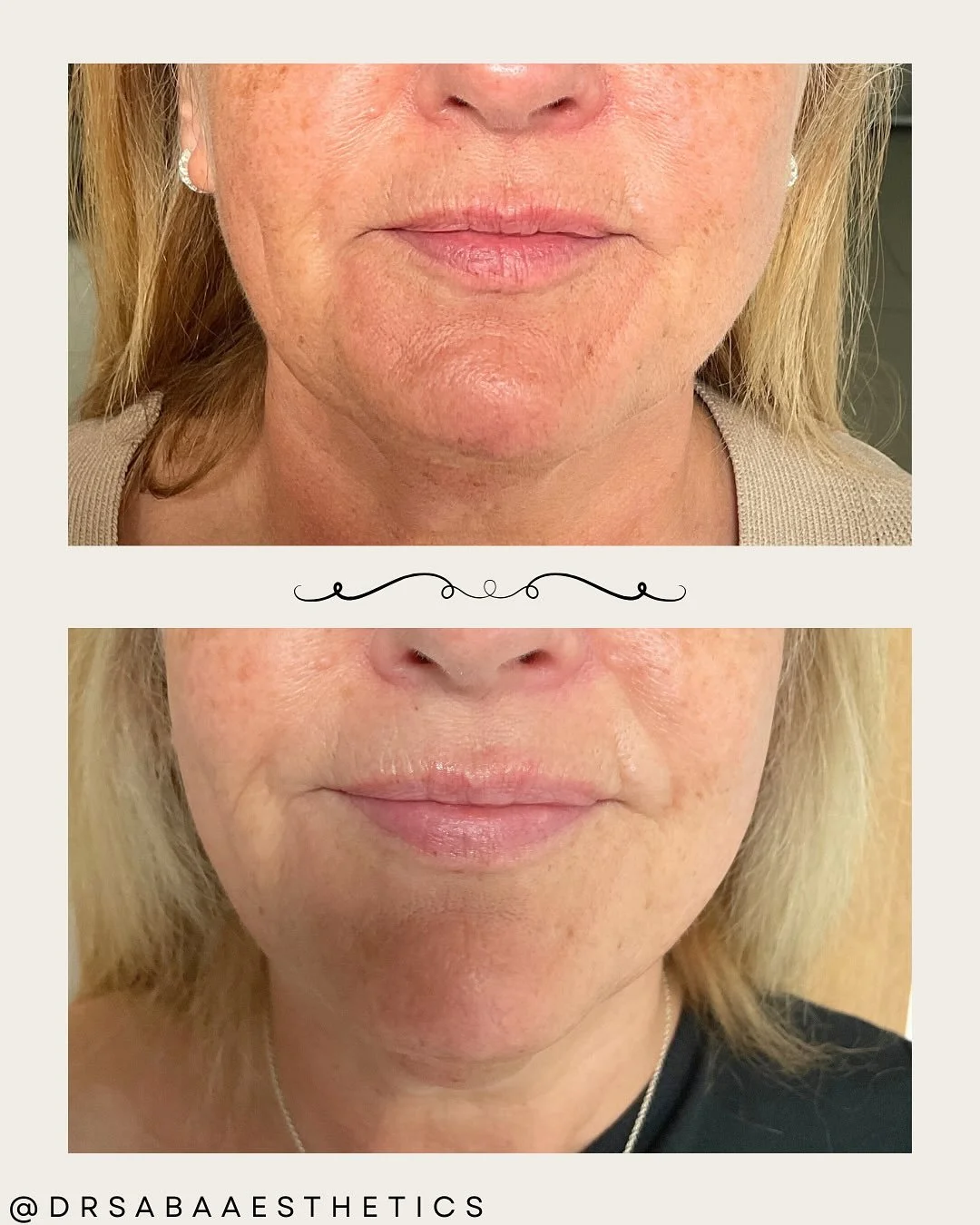 π Can you spot the tweakment(s) this lovely lady has had?
She was concerned about peri oral lines (smokers or barcode lines) that had become more prominent over time.
I’ll give you a clue - Absolutely zero filler whatsoever. β
Let’s