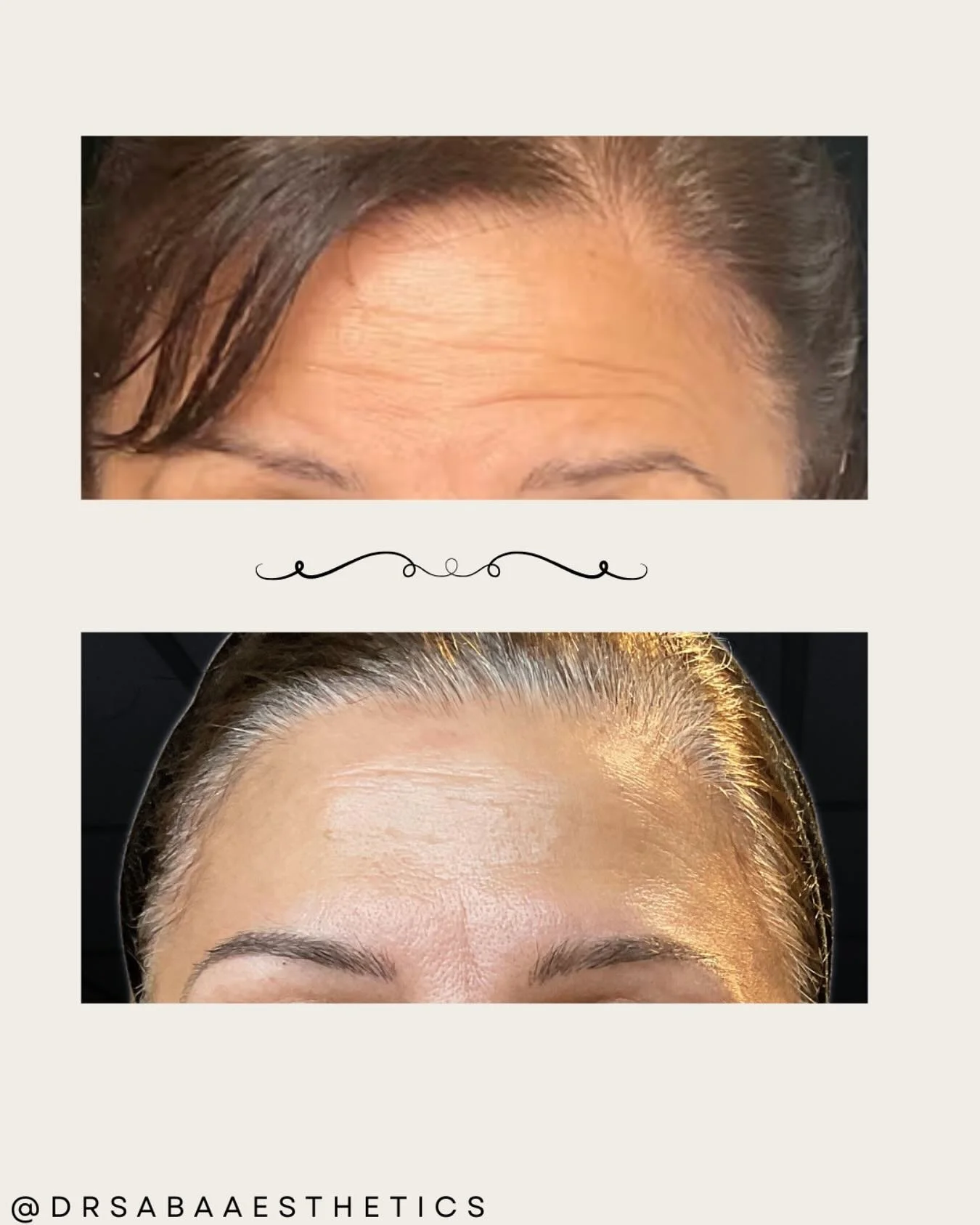 Tox Tweakment Tuesdays π β¨
A subtle, yet elegant brow lift has been achieved by treating 3 areas of the upper face with anti wrinkle toxin.
π€«Psssssssst!!
Free consultations all Summer π
π Bookings
-Link in Bio π±
-DM π²
-Email drsabaaesthe