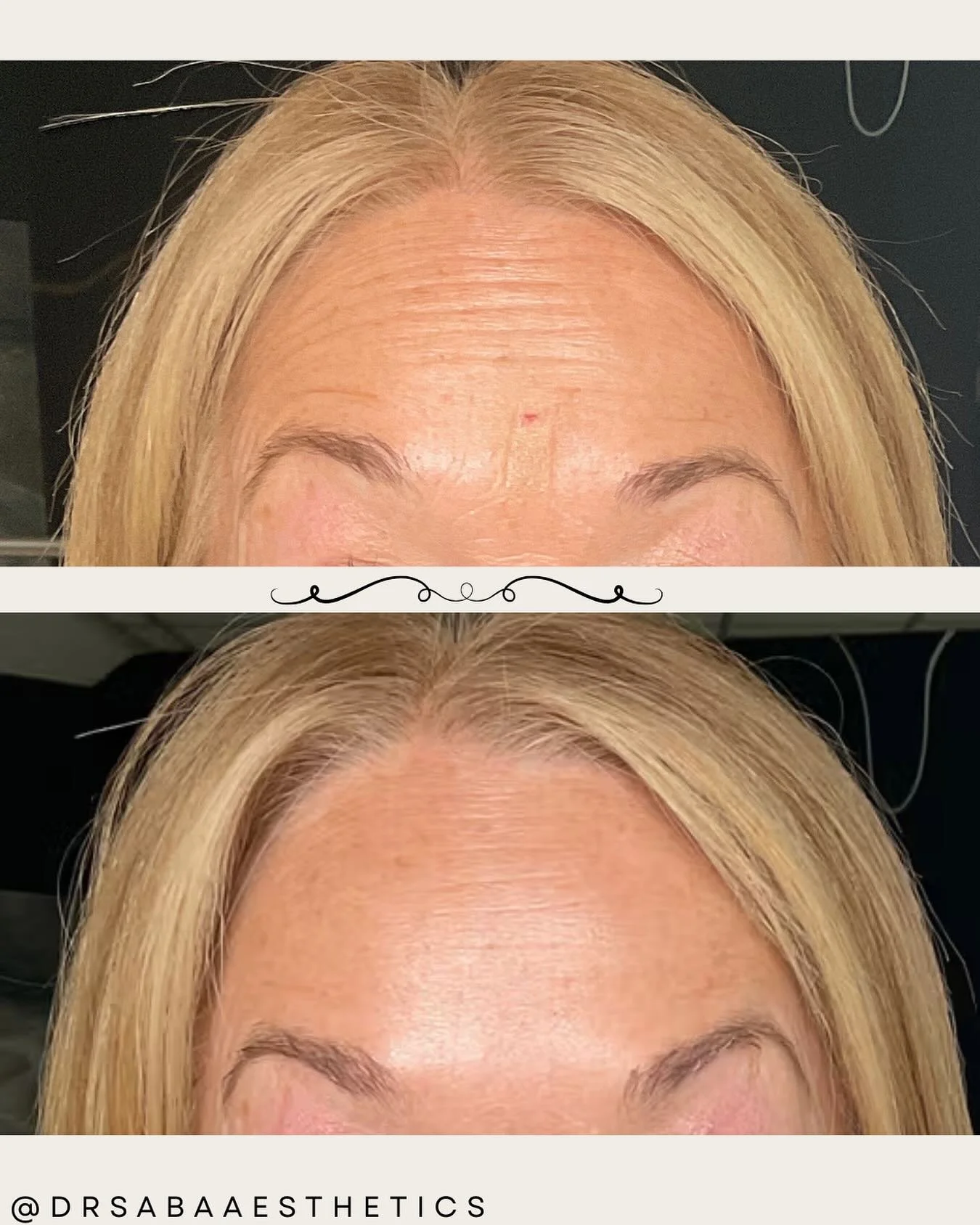 We love natural tox results! So undetectable ππΌ Anti wrinkle treatment not only helps with smoothing out fine lines but also with improving facial symmetry. Can you see how this beautiful client’s eyebrows are more aligned? π²Book now for 10%