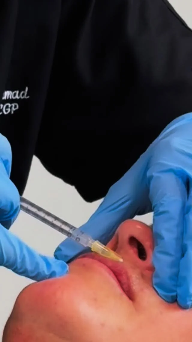 Care, consideration and clinical precision @drsabaaesthetics ๐ฉ๐ป‍โ๏ธ๐
#botox #doctor #aestheticspractitioner #filler #skinbooster #huddersfield #westyorkshire #leeds #york