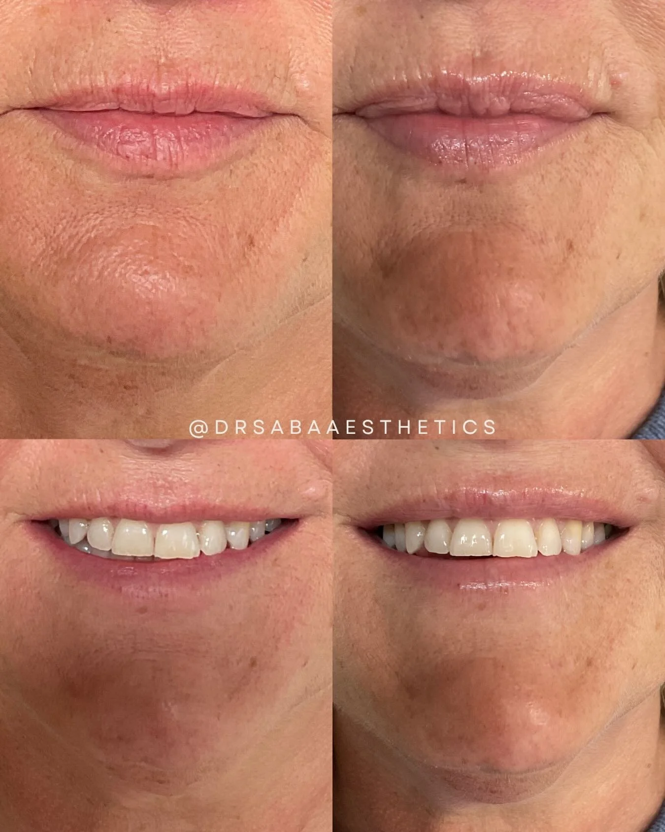 @drsabaaesthetics is in the business of natural tweakments ✨ 
Subtle lip enhancement using anti wrinkle toxin.

Love this result?

Book a free consultation!
Bookings taken via link in profile 📲

#botox #filler #aestheticsdoctor #huddersfield #tweakm