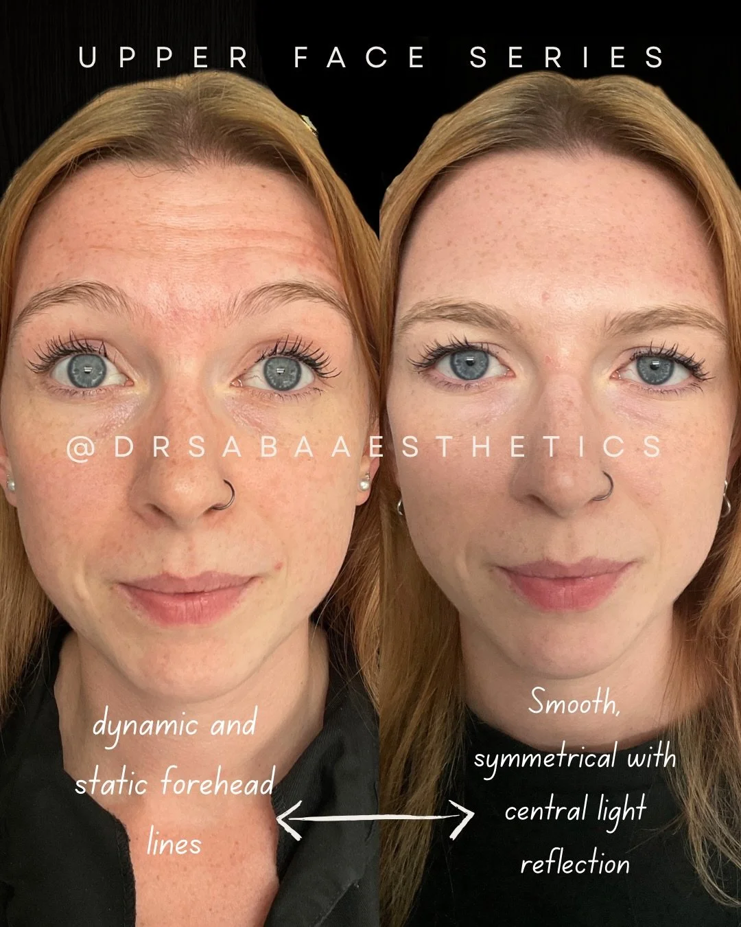 A Subtle, natural transformation 🤝 Dr Saba Aesthetics 🏆 

This lovely client was concerned about heaviness to her brow area and fine lines appearing around the eyes and mouth.
After a thorough consultation we arrived at a holistic approach to her t